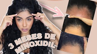 Minoxidil quanto tempo devo usar para ter resultado [upl. by Aneger501]