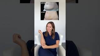 coolsculpting coolsculptingresults weightloss [upl. by Narba]