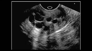 Ultrasound of cervix and cervical canal [upl. by Bensky]