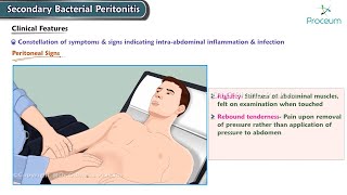 Secondary Bacterial Peritonitis Etiology Clinical features Diagnosis Management Surgery [upl. by Thorny945]