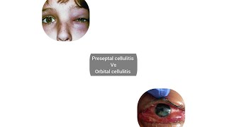 Preseptal cellulitis vs Orbital cellulitis causes signssymptoms treatment Explained 👁️ [upl. by Ynnel395]