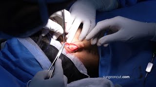 Ear Pinning Otoplasty for a Man  Complete Surgery [upl. by Cort]