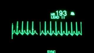 SVT with Synchronized Cardioversion [upl. by Arykahs]