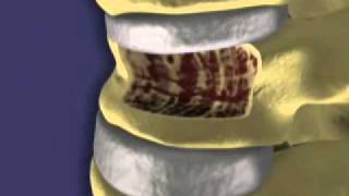 Balloon Kyphoplasty for Vertebral Compression Fractures [upl. by Amir]