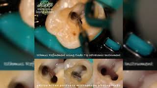 Endodontic Treatment  How To Clean Isthmus in Molar [upl. by Dnaltroc]