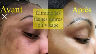 Comment se débarrasser des taches noires du visage rapidement [upl. by Melamie]