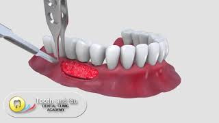 Free Gingival Graft [upl. by Revell]