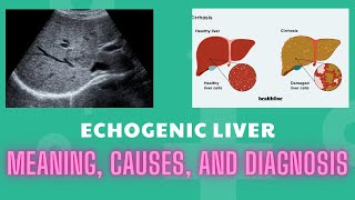 Echogenic Liver Meaning Causes And Diagnosis [upl. by Hale]