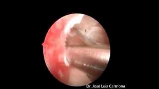 Histeroscopia estenosis cervical OCE  atrofia endometrial Dr Jose Luis Carmona Garcia [upl. by Adlesirk383]