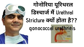 मूत्रमार्ग निंदा urethral stricture Kyun Hota haiGONOCOCCAL URETHRITIS URETHRAL DISCHARGE [upl. by Akemed419]