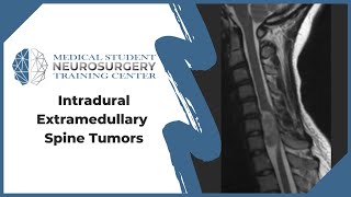 Intradural Extramedullary Spine Tumors [upl. by Nnovahs65]