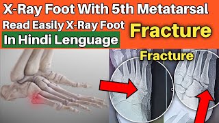 5th metatarsal fracture  Read Easily XRay Foot in hindi [upl. by Anelat]