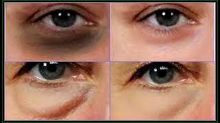 BAKING SODA AND CUCUMBER REMOVE DARK CIRCLES PUFFY EYES AND EYES BAGS Live DemoKhichi Beauty [upl. by Penthea]