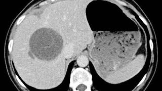 Why Liver Abscess is common on the right lobe [upl. by Anet]