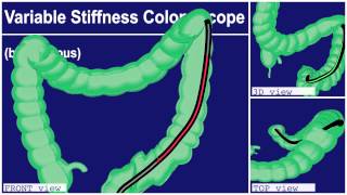 Colonscopy Video 3D Splenic Flexure Intubation [upl. by Leamse]