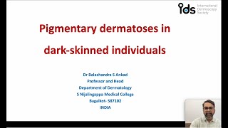 Pigmentary Dermatosis in dark skinned individuals  Dr Balachandra Ankad [upl. by Aleit]