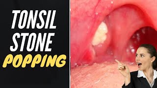 Tonsil Stone Removal  Popping Tonsil Stones [upl. by Ailemrac306]