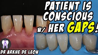 Closing The Patients Gaps with Direct Composite Technique C24 [upl. by Glen181]