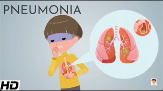 Pneumonia Everything You Need To Know [upl. by Kyred]