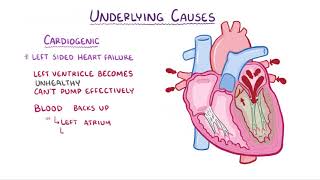 Pulmonary Edema causes symptoms diagnosis treatment pathology [upl. by Dorahs408]