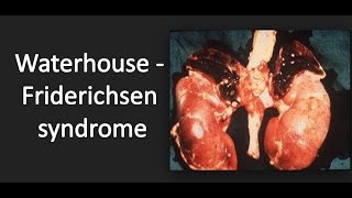 WaterhouseFriderichsen syndrome WFS [upl. by Fletch]