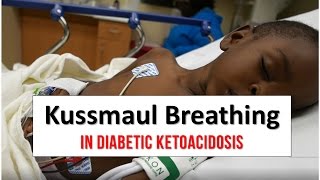 Kussmaul Breathing in Diabetic Ketoacidosis [upl. by Jara]