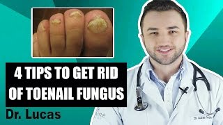 4 Tips to get rid Toenail Fungus  Dr Lucas Fustinoni Brazil [upl. by Rodolfo]