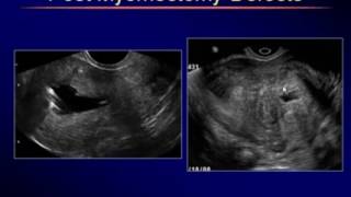 Sonography of Uterine Myometrial Disorders [upl. by Mchail748]