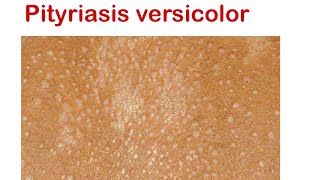 Pityriasis versicolor  superficial fungal infection [upl. by Jaan]