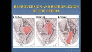 PT Retroversionflexion [upl. by Eintroc]