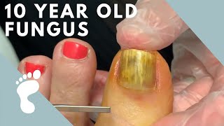 Fungus Takes Over Toenail  Toenail Removal [upl. by Aniv827]