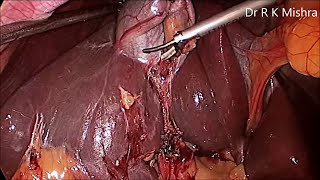 Gallbladder Stone Surgery [upl. by Aiasi]