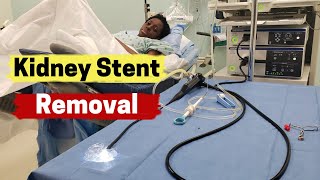 Kidney Stent Removal  What is Involved in Kidney Stent Removal [upl. by Flessel]