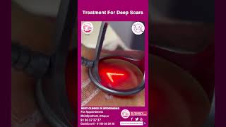 Deep Scar Removal Treatment  Laser Treatment For Deep Scars  Dr Vimalas Skin Hair amp Laser Centre [upl. by Aiyt]