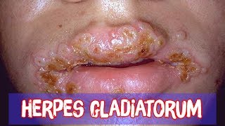 What is herpes gladiatorum [upl. by Kepner118]