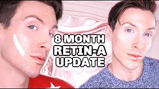 MY FIRST 8 MONTHS ON RETINA Before and After Results [upl. by Bunow]