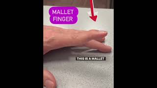 how to fix mallet finger injury mallets physio physicalfitness exercise rehab pain [upl. by Simeon768]