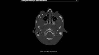 Tomografia Anatomia da Base do Crânio [upl. by Bridwell]