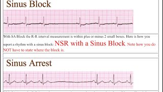 EKG  sinus block vs sinus arrest  AdamStokes syncope [upl. by Ardnaeel]