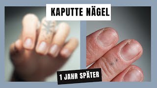 Kaputte Nägel  Das hilft [upl. by Esiled688]