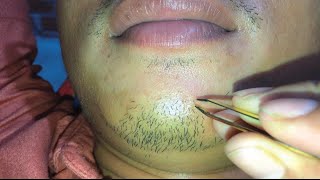 plucking beard for Mr Dongphucthai with yellow tweezers ASMR [upl. by Streeter]