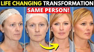 Mini Facelift Healing Progress [upl. by Airamalegna]