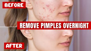 How to Treat Acne at Home That Works Amazingly [upl. by Zelazny]