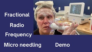 Fractional Radio Frequency Micro Needling For Home Use Demo [upl. by Aniras308]