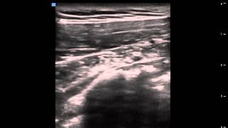 SONOANATOMIA PARA BLOQUEO INTERPECTORAL PECS BLOCKDR ESPINOZA [upl. by Weinert]