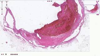 Atheromatous Plaque with Thrombosis  Histopathology [upl. by Refenej]