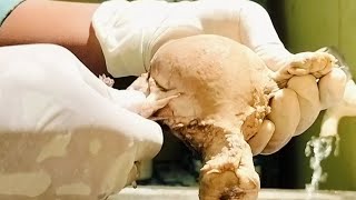 How To Gross uterus cervix uterinefibroid histopathology gross [upl. by Eilyab]