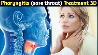 Pharyngitis sore throat infection treatment 3D animationHindiUrdu by Saeed pharma [upl. by Jea]