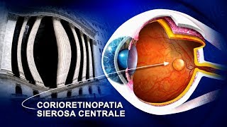 Corioretinopatia sierosa centrale CSCR terapia wwwoculisticaTVit [upl. by Nnylirej]