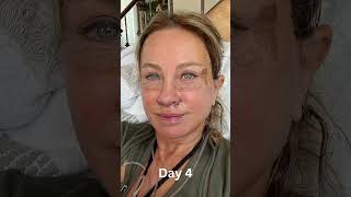 Daybyday Facelift Recovery and Healing Process [upl. by Ilzel]